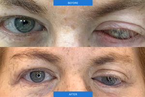 Before and After