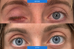 Before and After
