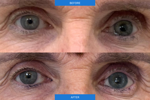 Before and After