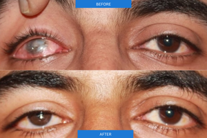 Before and After
