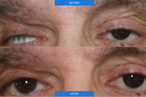 Before and After