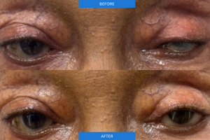 Before and After